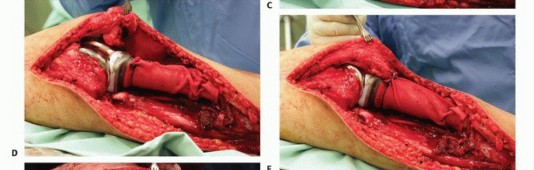 Illustration 36 for Tackling Complex Tumors of the Proximal Tibia: Limb-Sparing Solutions