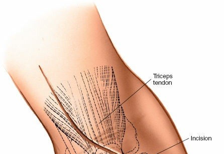 Illustration 4 for Mastering Elbow Approaches: Applied Surgical Anatomy for Precision