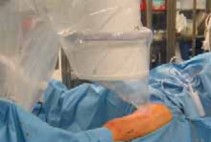 Titanium Elastic Nails: Effective Femoral Fracture Nailing