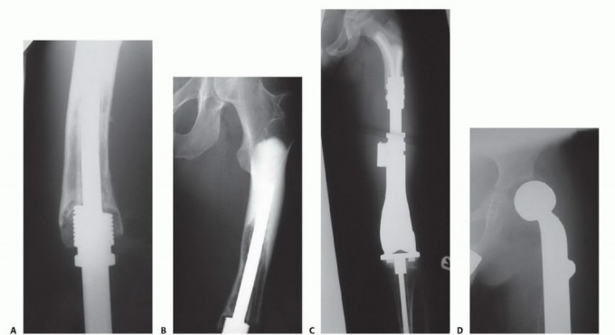 Illustration 13 for Expandable Prostheses: Understanding Infection Risk for Young Patients