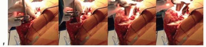 Illustration 9 for Removal of Well-fixed Components: Safe Techniques for Revision TKA