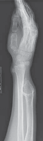 Strategic Forearm Osteotomy for Multiple Cartilaginous Exostoses
