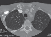 Illustration 6 for Mastering Pediatric Shoulder Fractures: Clinical Insights