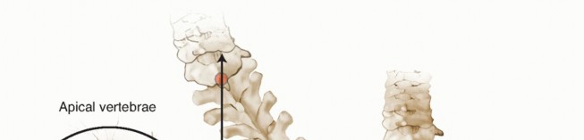 Illustration 10 for Adult Scoliosis: Uncover Causes & Find Lasting Back Pain Relief