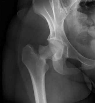 Femoral Neck Fracture Case Study: Comprehensive Clinical and Diagnostic Approach