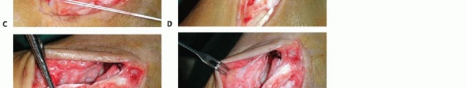 Illustration 29 for Medial Ankle Instability: Find Relief with Reconstruction