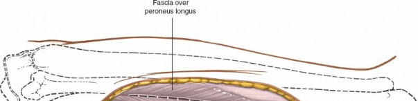 Illustration 75 for Surgical Access: Mastering the Tibia's Surface & Fibula Approaches