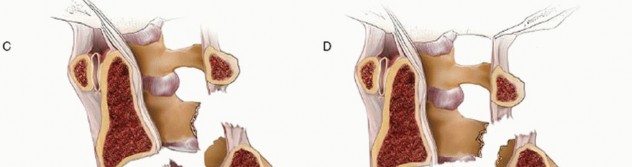 Illustration 17 for Master Techniques for Cervical Fracture Reduction: Type III & More