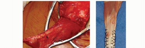 Illustration 21 for Restore Shoulder Function with Latissimus Dorsi Tendon Transfer