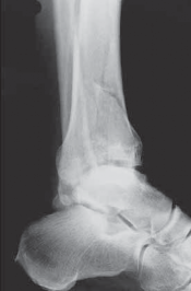 Illustration 41 for Optimizing ORIF for Tibial Plafond Fractures: A Modern Approach