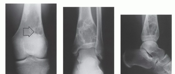 Illustration 16 for Understanding Benign Bone Tumors: Your Complete Preoperative Guide