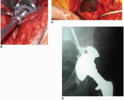 Illustration 3 for Uncemented Acetabular Component: Augments & Cup-Cages for Bone Loss