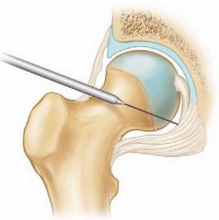 Illustration 19 for Solving Hip Soft Tissue Pathology with Advanced Arthroscopy