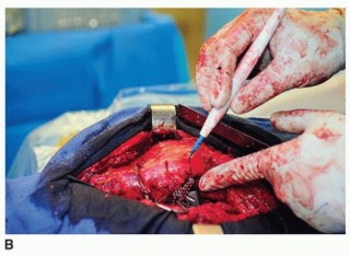 Illustration 50 for Cement in Cement Revision: Simplifying Complex Hip Revisions