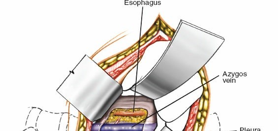Illustration 325 for Approach to the Lumbar Spine: Mastering Techniques & Anatomy