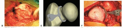 Illustration 5 for Hip Resurfacing: The Bone-Sparing Solution around the Femoral Head