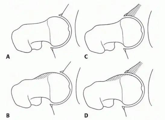 تخفيف الانحشار الفخذي الحقي الأمامي: نهج الجراحة المفتوحة المصغرة مع الأستاذ الدكتور محمد هطيف