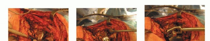 Illustration 6 for Hip Reimplantation Surgery: The Solution for Infected Implants