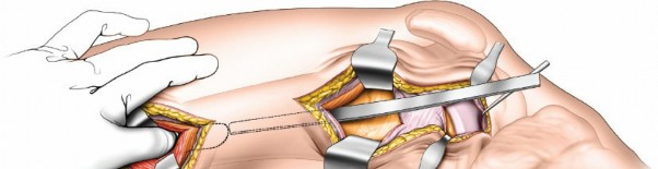 Illustration 57 for Optimal Femoral Approaches: Mastering the Lateral Intermuscular Septum