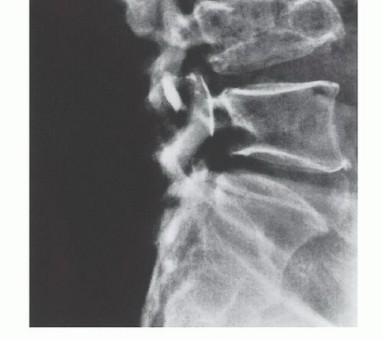 Illustration 13 for Understanding Benign Bone Tumors: Your Complete Preoperative Guide
