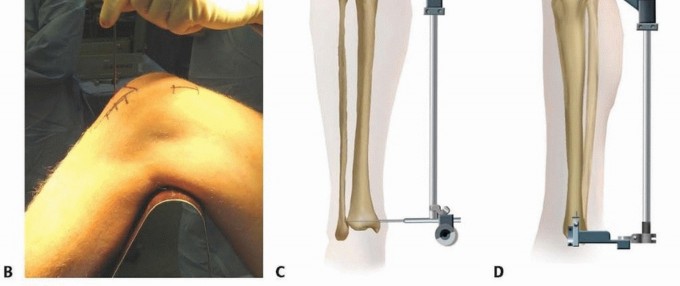 Illustration 16 for Advanced Nailing of the Mature Tibia: Overcoming Complexities