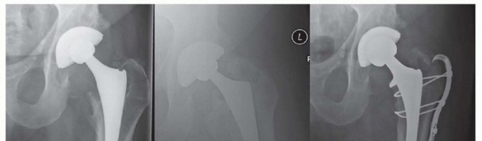 Illustration 5 for Mastering Fixation of Periprosthetic Fractures of the Femur