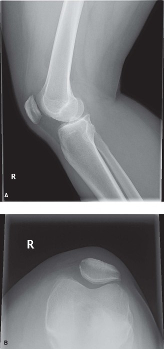 Lachman and Anterior: 4 Cases Where You Miss the Diagnosis