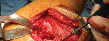 Illustration 18 for Optimizing Arthroplasty in Acute Fractures: Octopus System