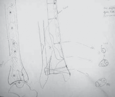 Illustration 24 for Optimizing ORIF for Tibial Plafond Fractures: A Modern Approach