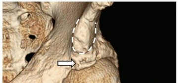 Illustration 6 for Beyond Knee Surg: Hip Arthroscopy for Sports Injuries
