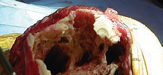 Illustration 35 for Hinged Total Knee: The Salvage Solution for Challenging Cases