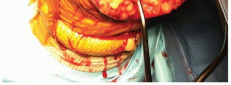 Illustration 46 for Surgical Approaches to Shoulder & Elbow: Pearls and Pitfalls