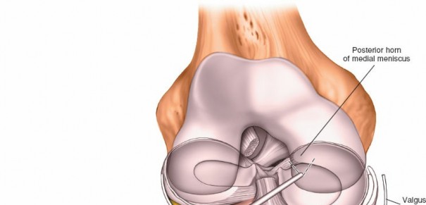 Illustration 17 for Mastering Knee Arthroscopy Approaches: Safely Withdraw the Arthroscope
