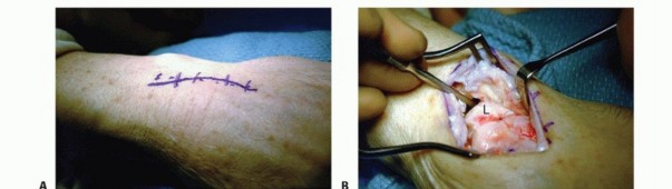  Limited Wrist Arthrodesis