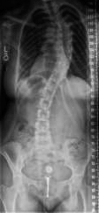 Illustration 3 for Pediatric Scoliosis: When Curves Are Larger Than Degrees, What's Next?