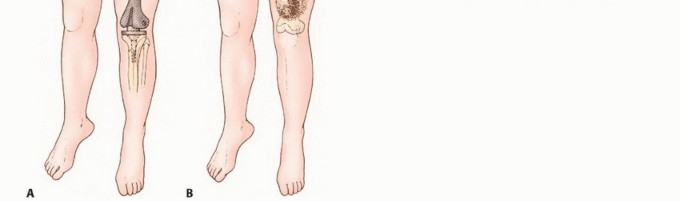 Illustration 2 for Mastering Above-Knee Amputation: Essential Surgical Insights