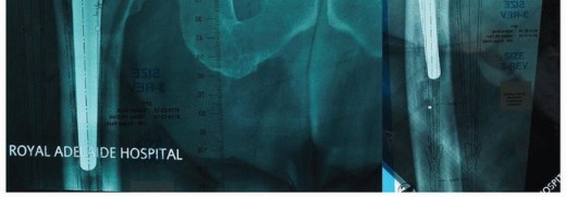 Illustration 2 for Cement in Cement Revision: Simplifying Complex Hip Revisions