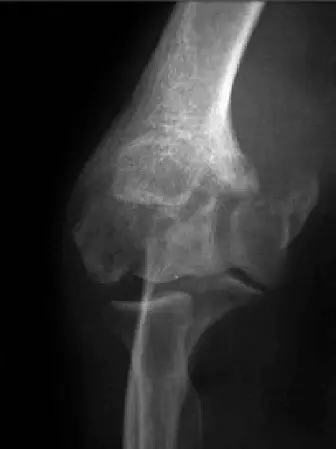 خشونة مفصل الكوع بعد الإصابة لدى الشباب: دليل شامل للعلاج والتعافي مع الأستاذ الدكتور محمد هطيف