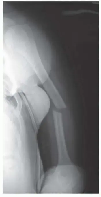 دليلك الشامل لكسور عظم العضد: التشخيص، العلاج، والتعافي مع الأستاذ الدكتور محمد هطيف