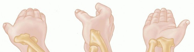 Open Reduction and Internal Fixation of Radial Head and Neck Fractures