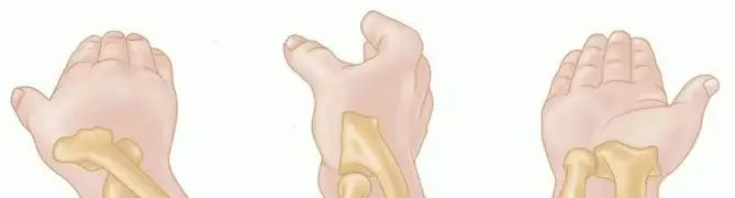 صورة توضيحية لـ كسور رأس وعنق الكعبرة: دليلك الشامل لاستعادة حركة مرفقك ونشاطك