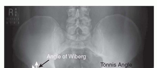 Illustration 7 for Anterior FAI Relief: Mini-Open Anterior Approach Explained