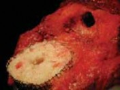 Illustration of arthroplasty with tibial bone - Dr. Mohammed Hutaif