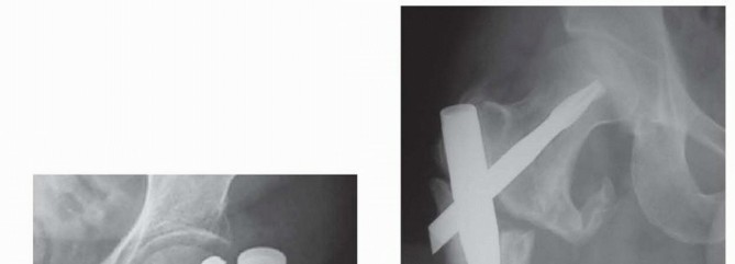 Illustration 33 for Achieve Optimal Femoral Head Fixation with Cephalomedullary Nailing