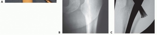 Illustration 24 for Is a Sliding Hip Screw Best for Your Femoral Neck Fracture?