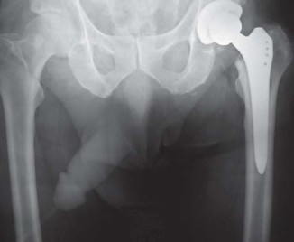 Illustration 43 for Robotics in Total Hip Arthroplasty: A New Era of Precision