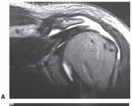 Illustration 4 for Restore Shoulder Function with Latissimus Dorsi Tendon Transfer