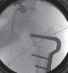 Illustration 27 for Increased Femoral Anteversion: A Proximal Femoral Rotational Osteotomy