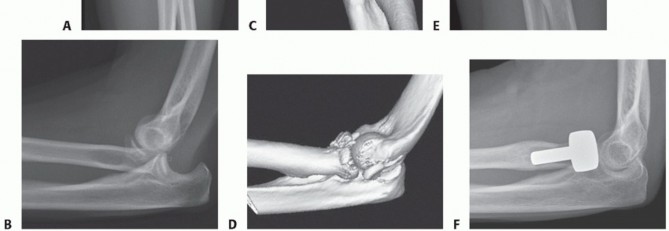 Illustration 4 for Radial Head Arthroplasty: Restoring Elbow Function & Stability