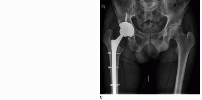 Illustration 15 for PJI of the Hip: Two-Stage Revision: When & How to Prepare